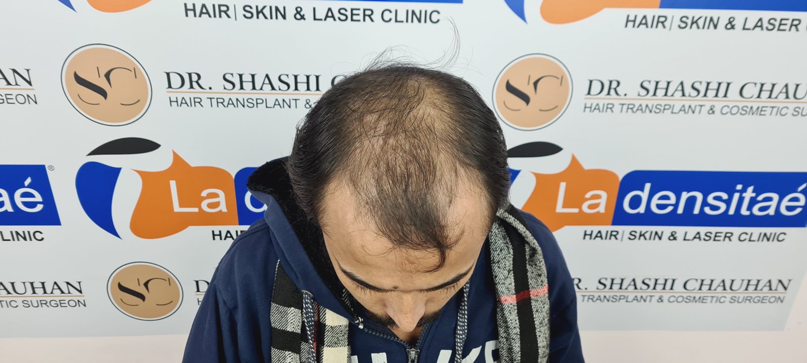 Ashis Yadav Before Hair Transplant